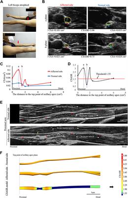 Application of a nerve stereoscopic reconstruction technique based on ultrasonic images in the diagnosis of neuralgic amyotrophy